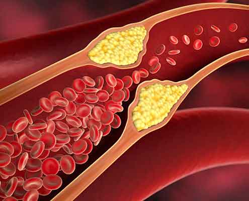 lipidberatung_495x400